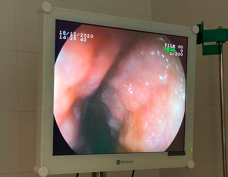 endoscopia-de-intestino-delgado
